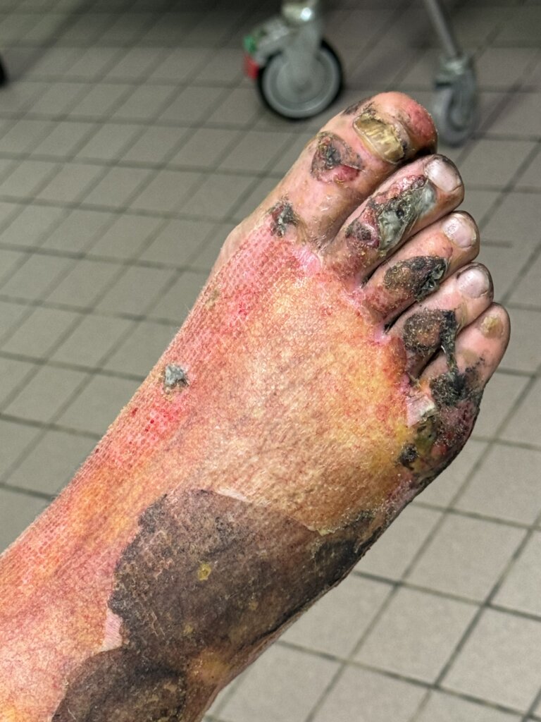 Клин случай_ожоги_2