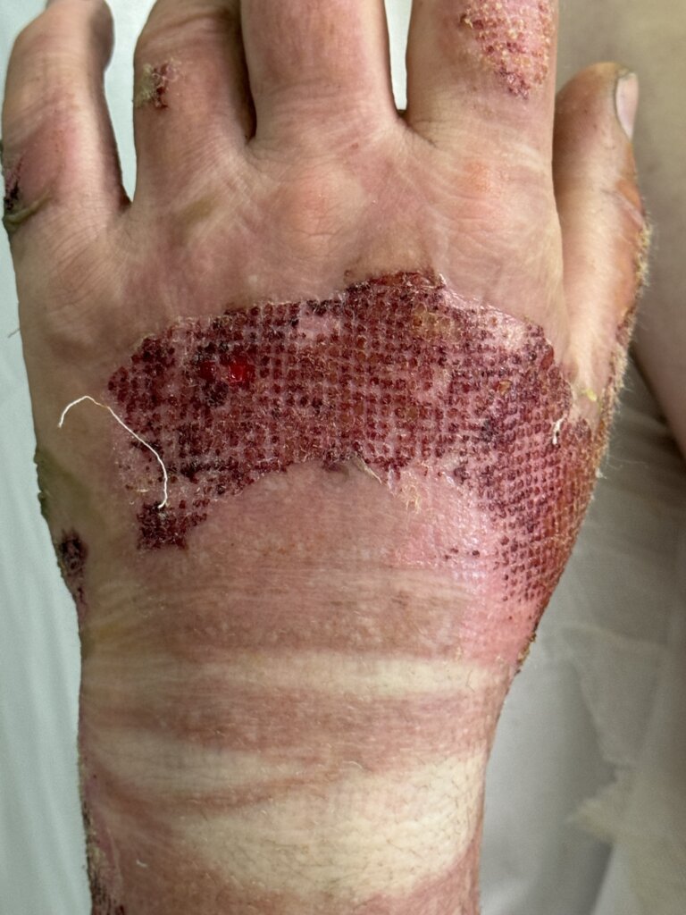 Клин случай_ожоги_3